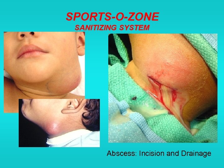 SPORTS-O-ZONE SANITIZING SYSTEM Abscess: Incision and Drainage 