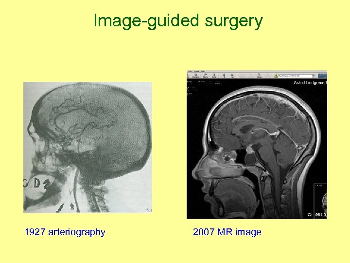 Image-guided surgery 1927 arteriography 2007 MR image 