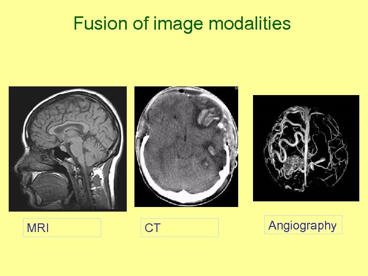 Fusion of image modalities MRI CT Angiography 