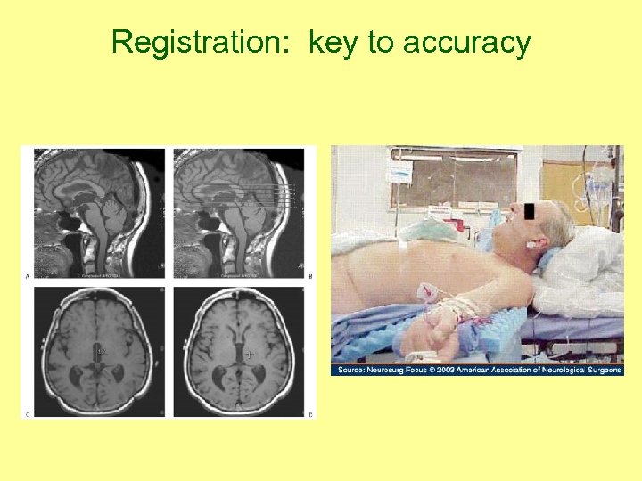 Registration: key to accuracy 