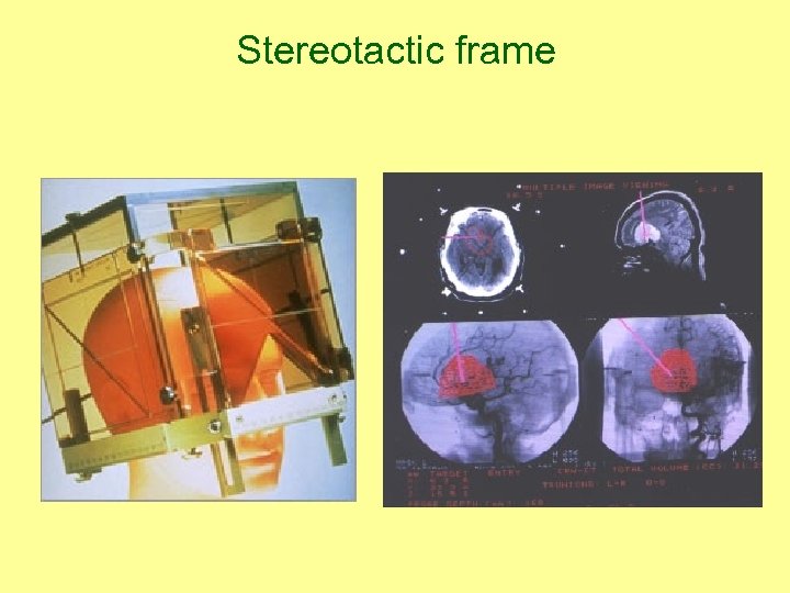 Stereotactic frame 