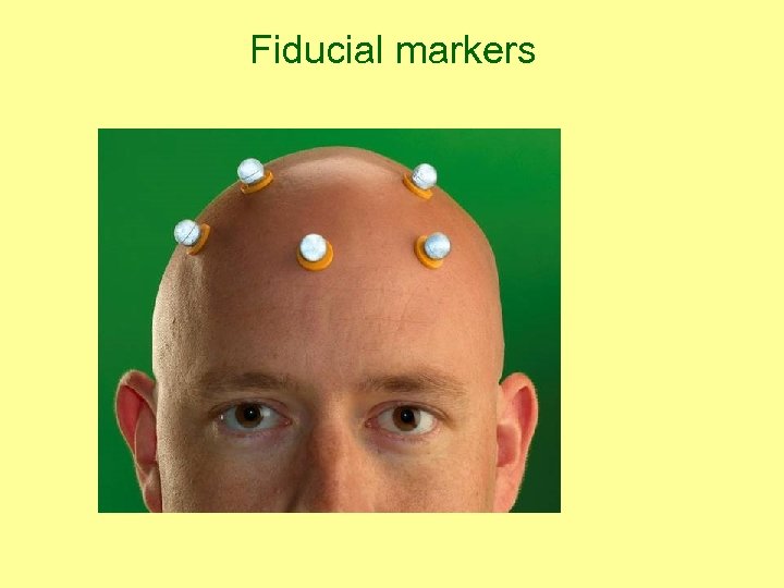 Fiducial markers 