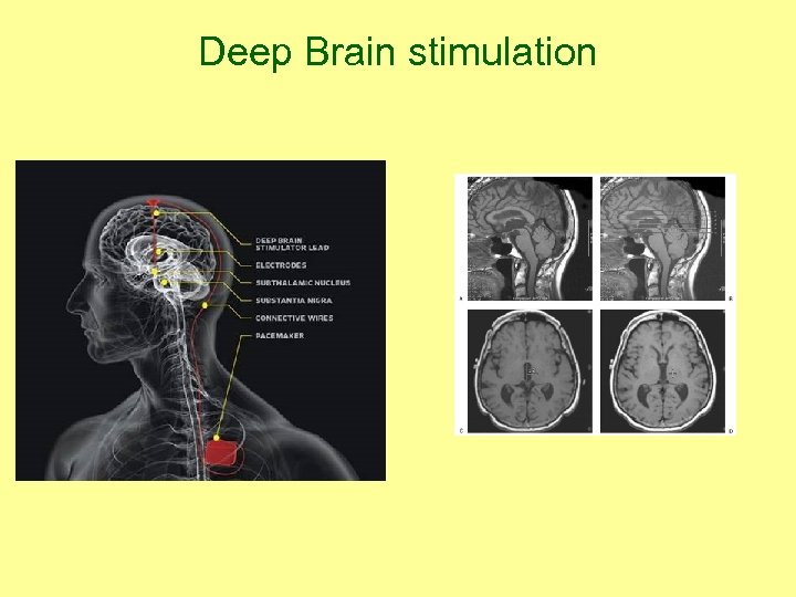 Deep Brain stimulation 