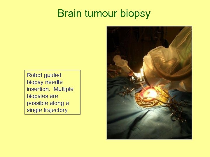 Brain tumour biopsy Robot guided biopsy needle insertion. Multiple biopsies are possible along a