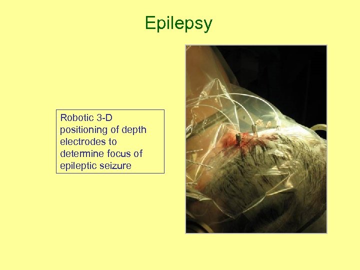 Epilepsy Robotic 3 -D positioning of depth electrodes to determine focus of epileptic seizure