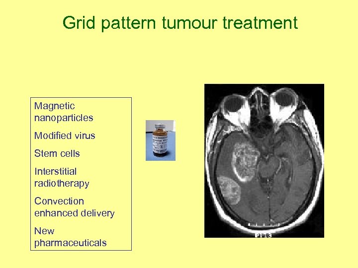 Grid pattern tumour treatment Magnetic nanoparticles Modified virus Stem cells Interstitial radiotherapy Convection enhanced