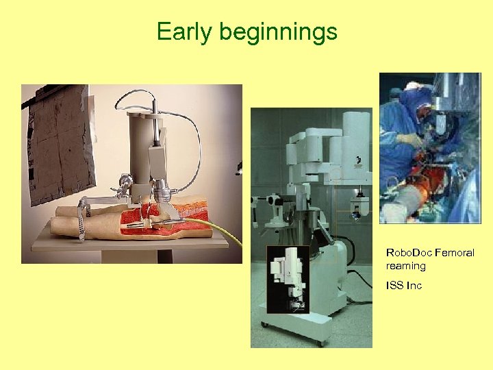 Early beginnings Robo. Doc Femoral reaming ISS Inc 