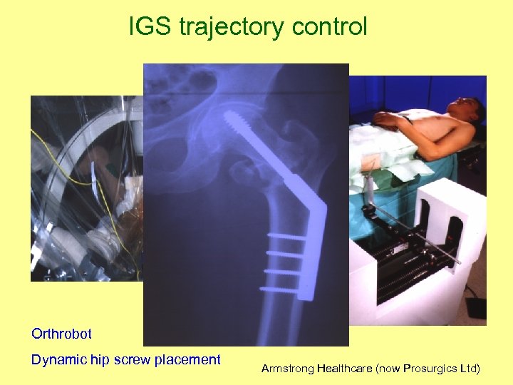 IGS trajectory control Orthrobot Dynamic hip screw placement Armstrong Healthcare (now Prosurgics Ltd) 