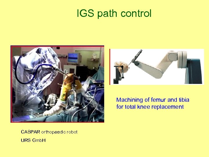 IGS path control Machining of femur and tibia for total knee replacement CASPAR orthopaedic