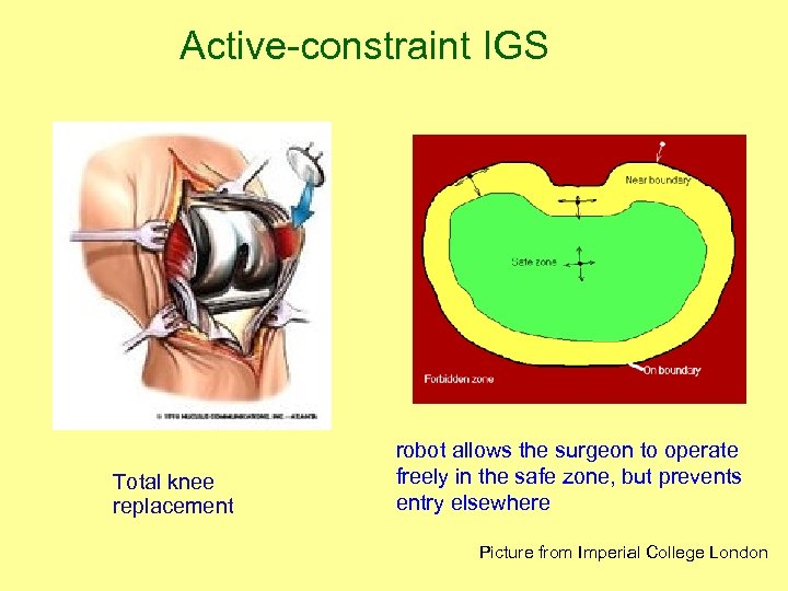 Active-constraint IGS Total knee replacement robot allows the surgeon to operate freely in the