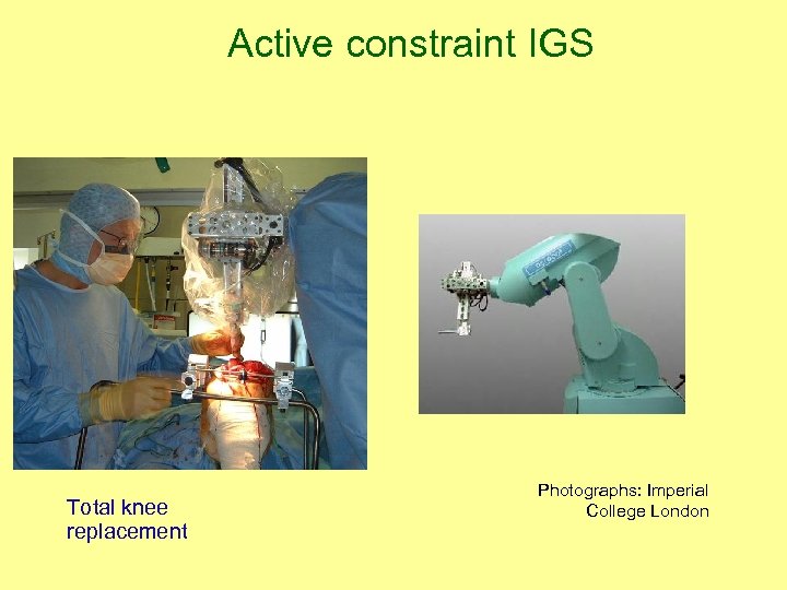 Active constraint IGS Total knee replacement Photographs: Imperial College London 