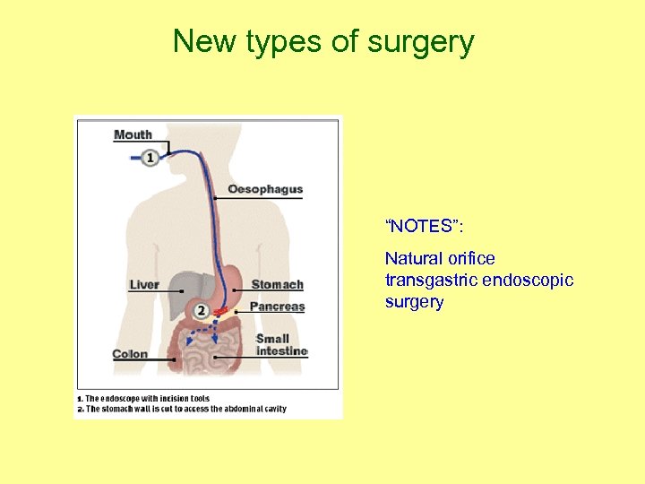 New types of surgery “NOTES”: Natural orifice transgastric endoscopic surgery 