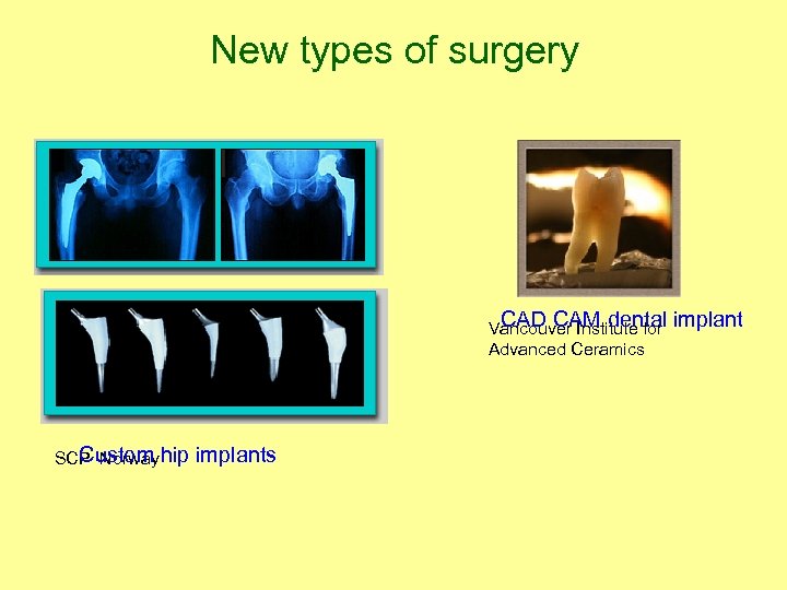 New types of surgery CAD CAM dental implant Vancouver Institute for Advanced Ceramics Custom