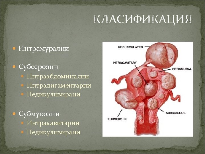 КЛАСИФИКАЦИЯ Интрамурални Субсерозни Интраабдоминални Интралигаментарни Педикулизирани Субмукозни Интракавитарни Педикулизирани 