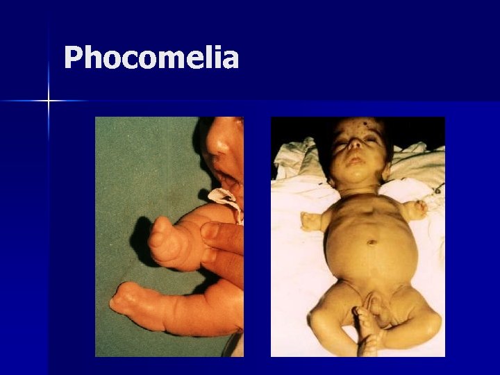 Phocomelia 