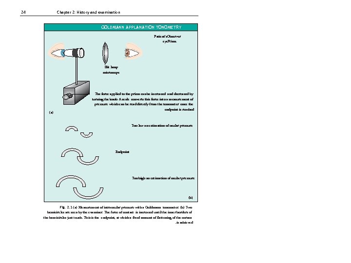 24 Chapter 2: History and examination GOLDMANN APPLANATION TONOMETRY Patient's. Observer eye. Prism Slit