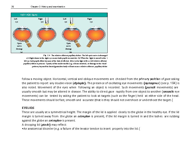 26 Chapter 2: History and examination TEST FOR RAPD Left Right eye eye Optic