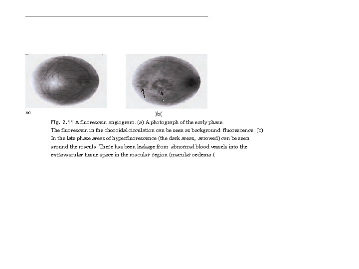 (a) )b( Fig. 2. 11 A fluorescein angiogram. (a) A photograph of the early