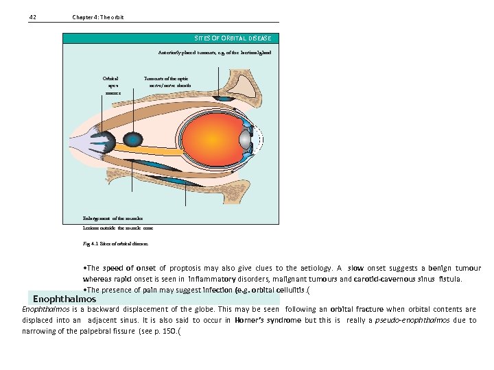 42 Chapter 4: The orbit SITES OF ORBITAL DISEASE Anteriorly placed tumours, e. g.