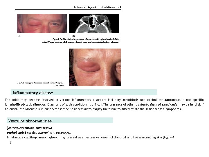 Differential diagnosis of orbital disease 45 (b) (a) . Fig. 4. 2 (a) The