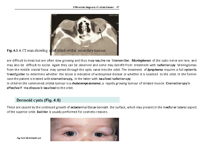 Differential diagnosis of orbital disease 47 Fig. 4. 5 A CT scan showing a