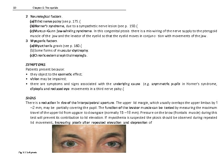 50 Chapter 5: The eyelids 2 Neurological factors. (a)Third nerve palsy (see p. 175.