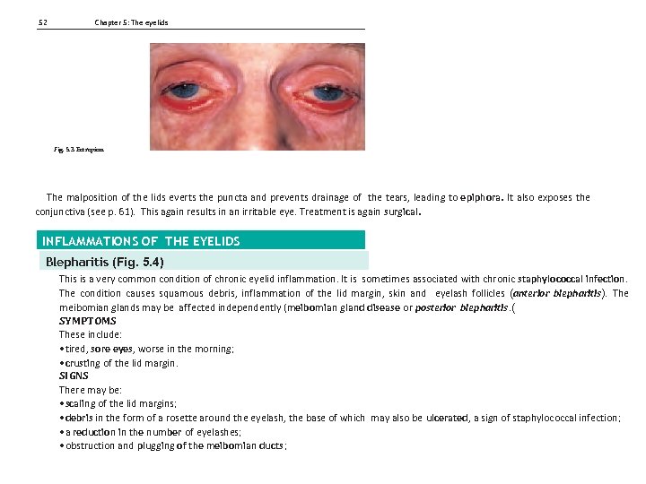 52 Chapter 5: The eyelids Fig. 5. 3 Ectropion. The malposition of the lids