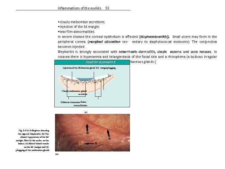 Inflammations of the eyelids 53 • cloudy meibomian secretions; • injection of the lid