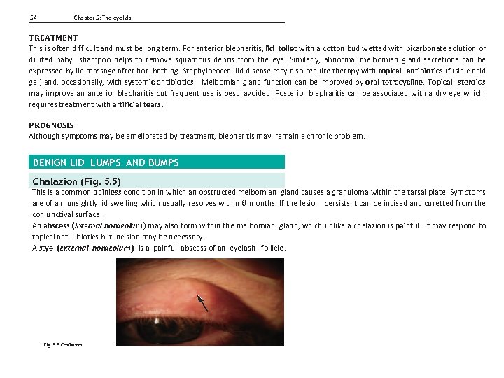 54 Chapter 5: The eyelids TREATMENT This is often difficult and must be long