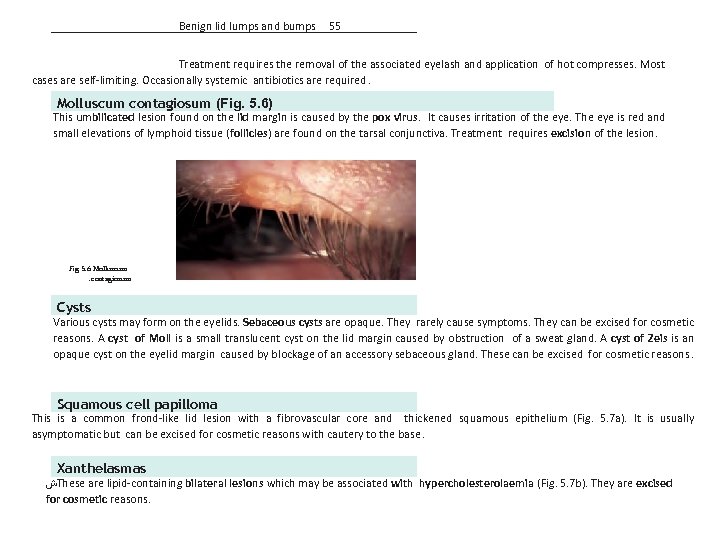 Benign lid lumps and bumps 55 Treatment requires the removal of the associated eyelash