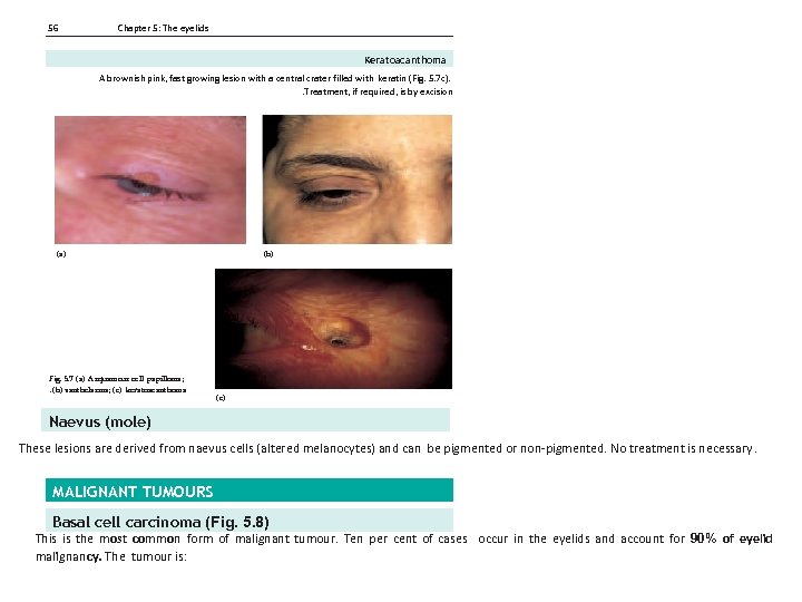 56 Chapter 5: The eyelids Keratoacanthoma A brownish pink, fast growing lesion with a