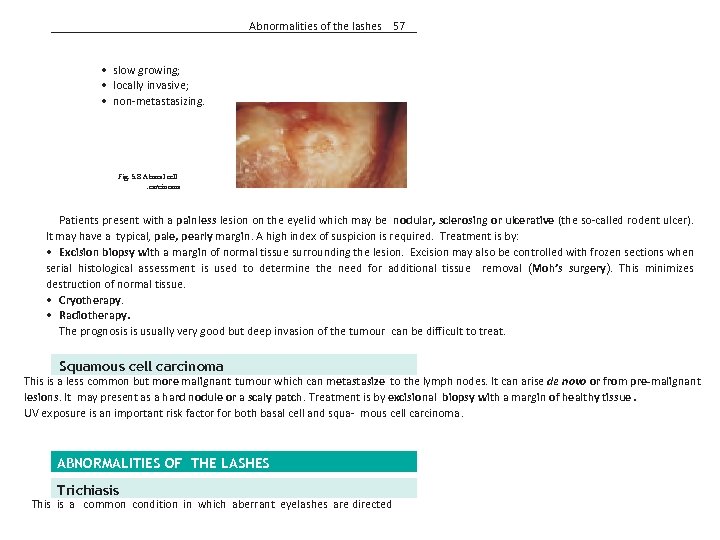 Abnormalities of the lashes 57 • slow growing; • locally invasive; • non-metastasizing. Fig.