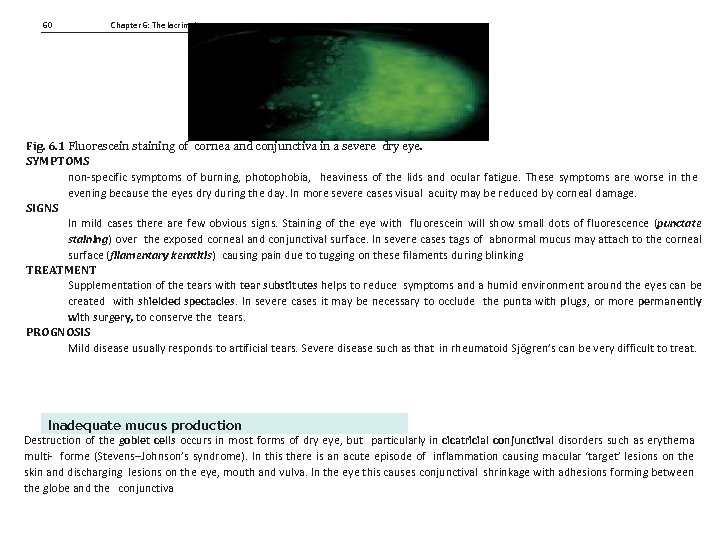 60 Chapter 6: The lacrimal system Fig. 6. 1 Fluorescein staining of cornea and