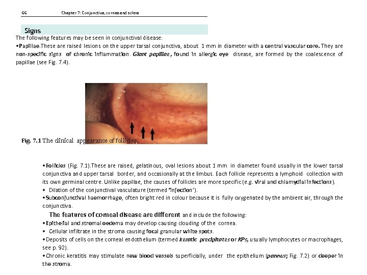 66 Chapter 7: Conjunctiva, cornea and sclera Signs The following features may be seen