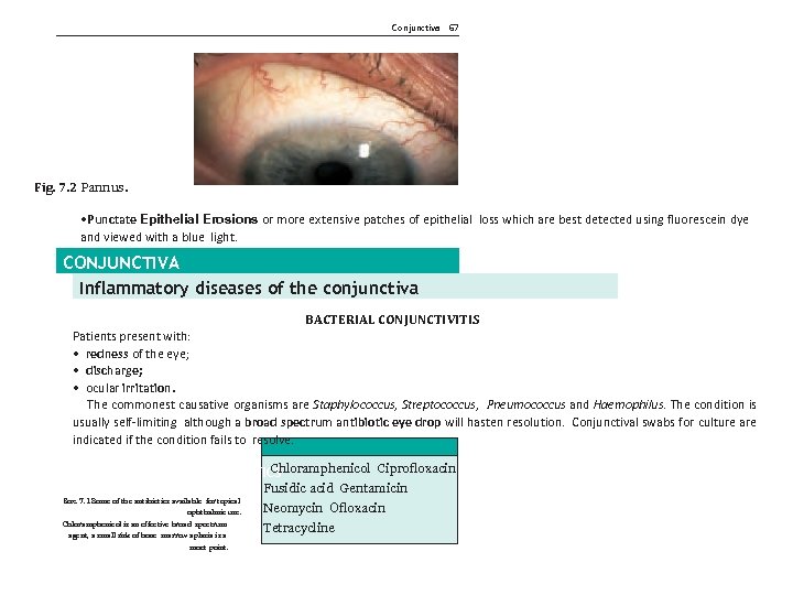 Conjunctiva 67 Fig. 7. 2 Pannus. • Punctate Epithelial Erosions or more extensive patches