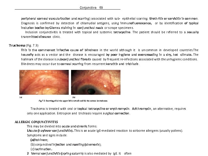 Conjunctiva 69 peripheral corneal vascularization and scarring) associated with sub- epithelial scarring. Urethritis or