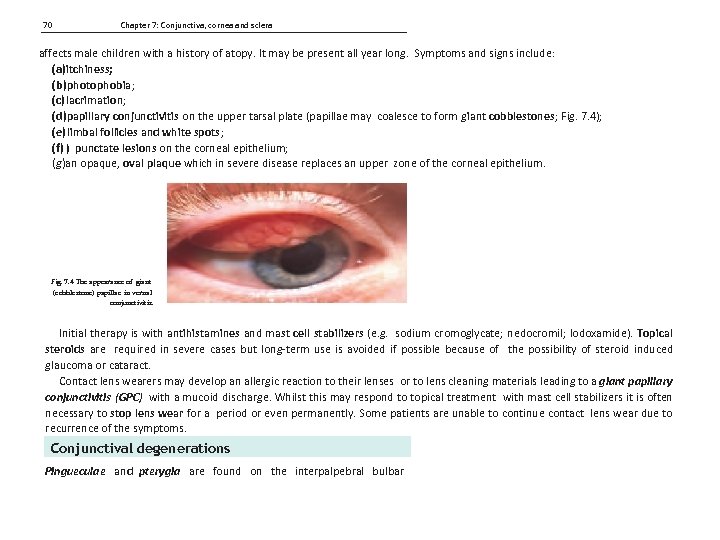 70 Chapter 7: Conjunctiva, cornea and sclera affects male children with a history of