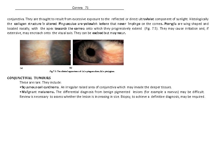 Cornea 71 conjunctiva. They are thought to result from excessive exposure to the reflected