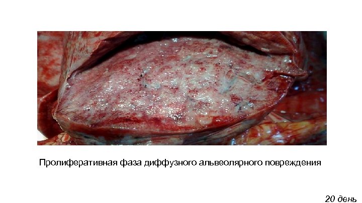 Пролиферативная фаза диффузного альвеолярного повреждения 20 день 
