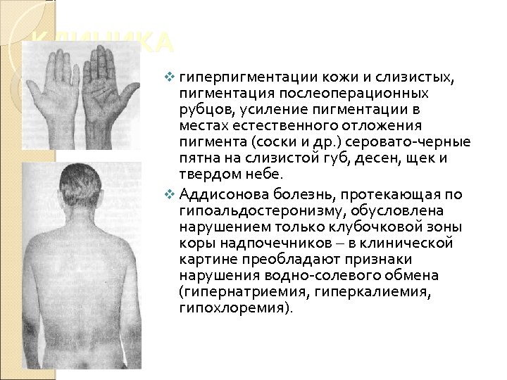 КЛИНИКА v гиперпигментации кожи и слизистых, пигментация послеоперационных рубцов, усиление пигментации в местах естественного