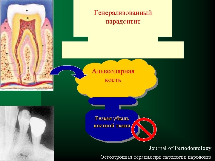 Генерализованный парадонтит Альвеолярная кость Резкая убыль костной ткани Journal of Periodontology Остеотропная терапия при
