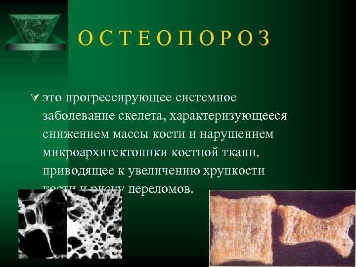 О С Т Е О П О Р О З Ú это прогрессирующее системное