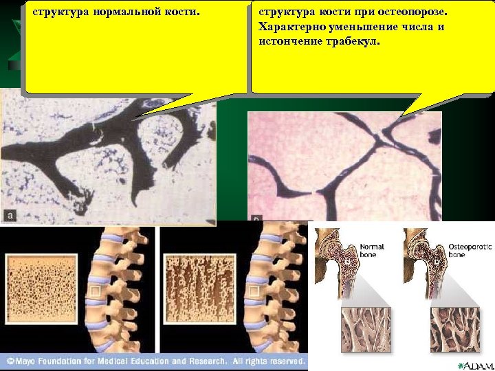 структура нормальной кости. структура кости при остеопорозе. Характерно уменьшение числа и истончение трабекул. 
