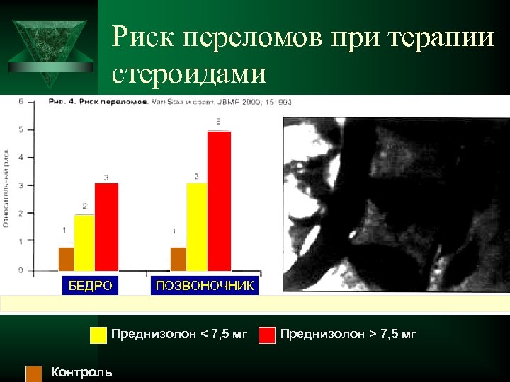 Риск переломов при терапии стероидами БЕДРО ПОЗВОНОЧНИК Преднизолон < 7, 5 мг Контроль Преднизолон