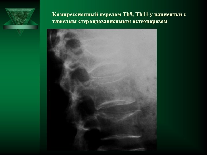 Компрессионный перелом Th 9, Th 11 у пациентки с тяжелым стероидозависимым остеопорозом 