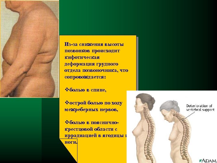 Из-за снижения высоты позвонков происходит кифотическая деформация грудного отдела позвоночника, что сопровождается: vболью в