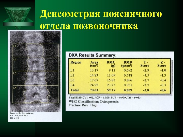 Денсометрия поясничного отдела позвоночника 