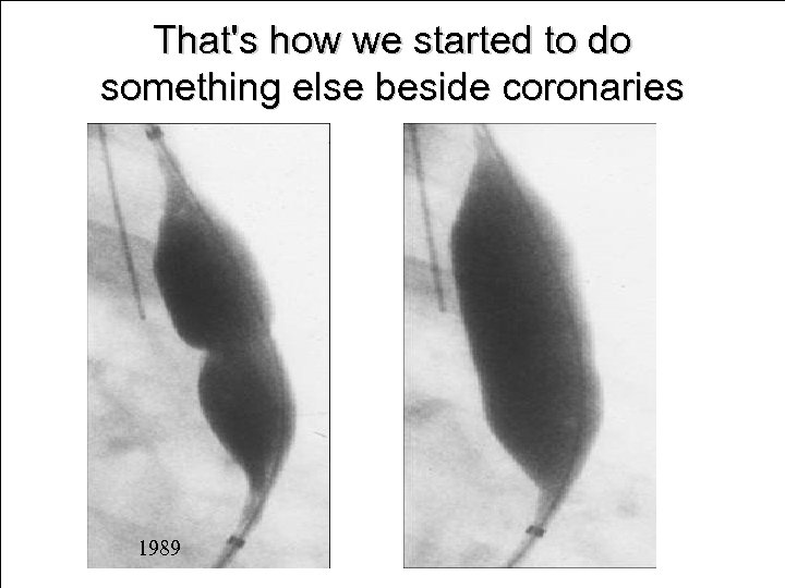 That's how we started to do something else beside coronaries 1989 