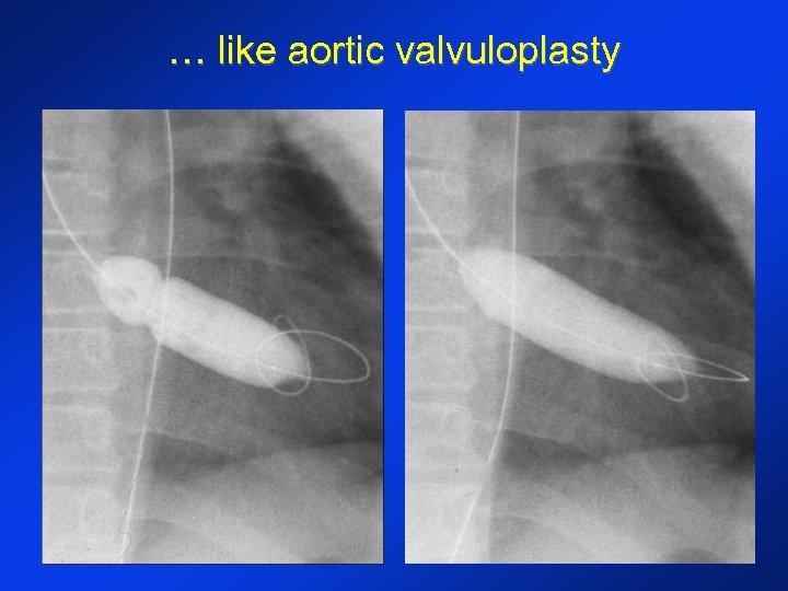 … like aortic valvuloplasty 