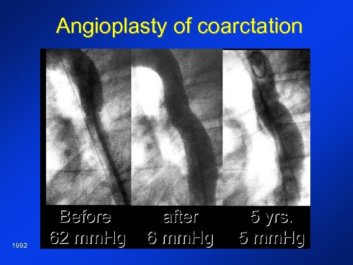 Angioplasty of coarctation 1992 